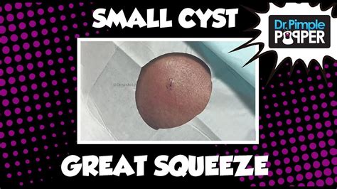 Cyst on the Right Cheek - YouTube