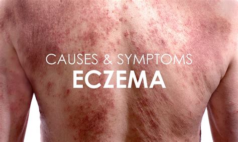 Eczema