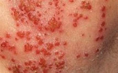 Eczema Herpeticum - What is it and is it dangerous? - Eczema Blues