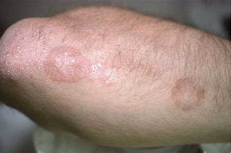 Nummular Eczema: 10 Symptoms Of Nummular Eczema