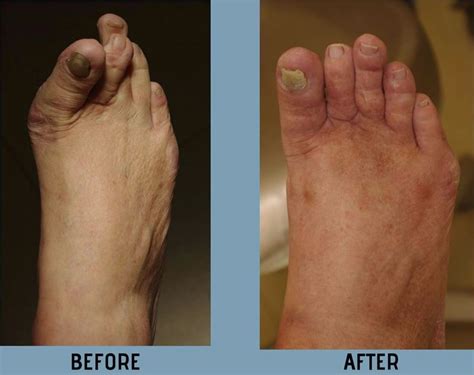 Cosmetic Foot Surgery Before and After | Corrective Foot Surgery New York