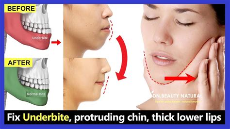 5 Exercises Fix Underbite without surgery, fix protruding chin, reduce ...