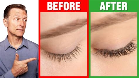 How to Grow Long Thick Eyelashes QUICKLY! - Dr. Berg - YouTube