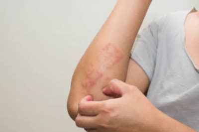 Causes of Itchy Bumps on Elbows and What to Do About This » Scary Symptoms