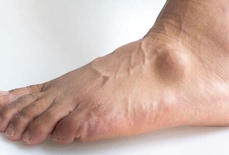 Lump On Top Of Foot: Common Causes & Treatment