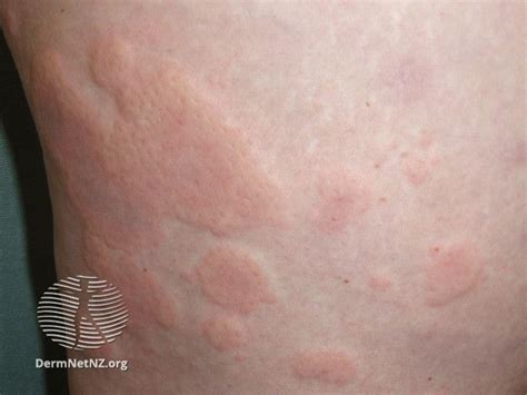 Allergy Rashes: Images, Symptoms, Treatment