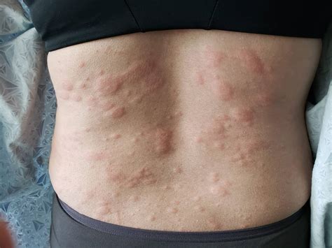 What Causes Me to Breakout into Hives? - Arlington Dermatology