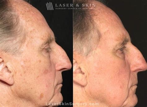 Laser Brown Spot Removal New York, NY | Laser Center