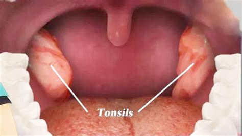 Tonsil Cancer Ke Lakshan In Hindi - Rima1