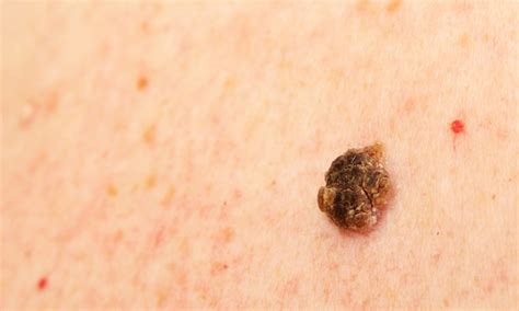 Is there a way to treat seborrheic keratosis? - Harvard Health