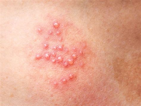 Shingles and Encephalitis: Symptoms, Causes, and Treatment