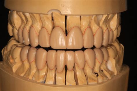 Taking Control of Vertical Dimension Changes in Dentistry: Control ...