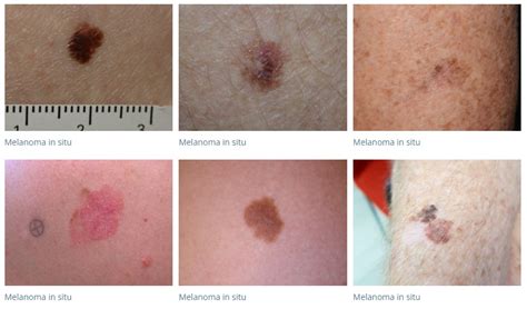 Melanoma in Situ – What is it and How did it affect me?