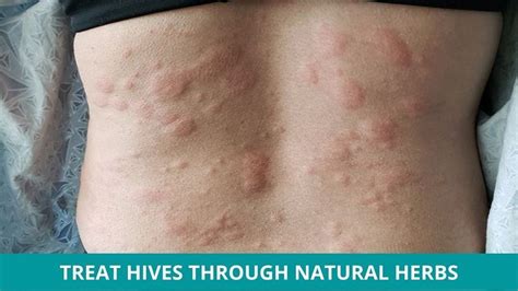 How to Treat Hives through Natural Herbs?