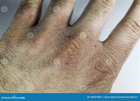 Close View of Dry and Cracked Hand Knuckles, Skin Problem Stock Image ...