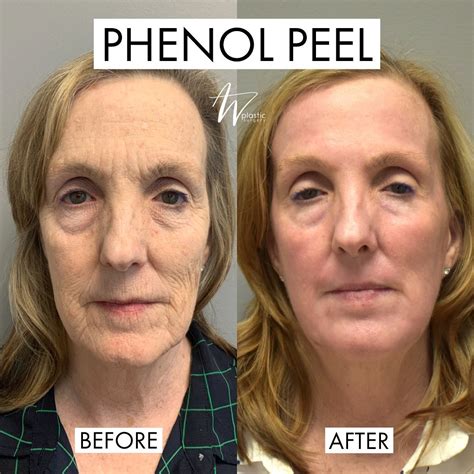 Phenol Peels: What to Know About the Controversial Treatment — See ...