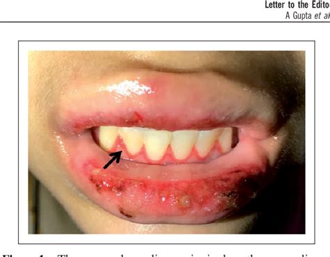 Linear Gingival Erythema