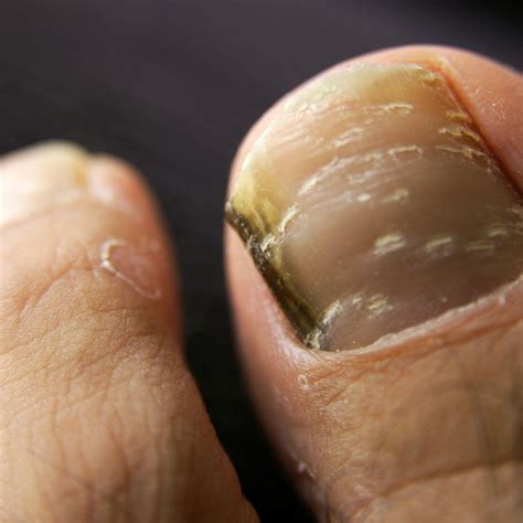 What is Black Toenail Fungus? – Forces of Nature Medicine