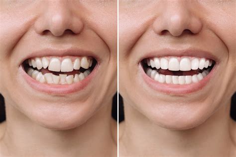 Best Veneers in Chicago | Porcelain Veneers in Chicago, Il | Dental ...