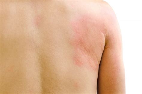 Chronic Hives - Hedberg Allergy