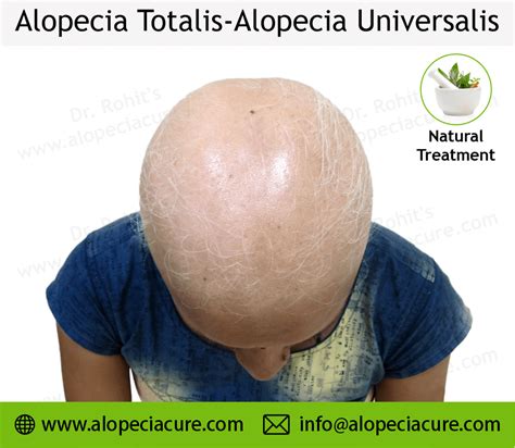 Alopecia Universalis