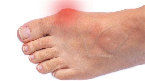 Bunions: Surgery, Treatment, Symptoms & Causes | The Feet People Podiatry