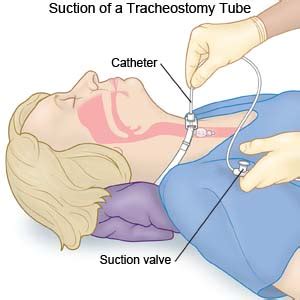 Tracheostomy Suctioning | New Health Advisor