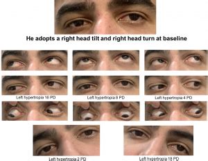 Fourth nerve palsy – Case-Based Neuro-Ophthalmology