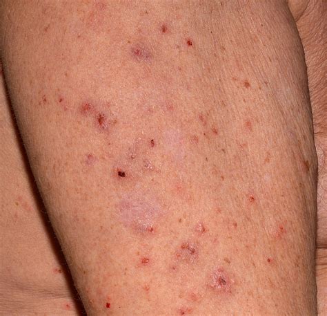 Scabies — Gateway Dermatology