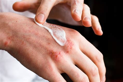 5 Tips to Prevent Eczema Flare-Ups | Garden City, NY & Syosset, NY ...