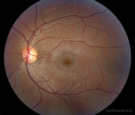 Purtscher Retinopathy