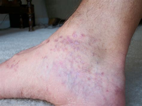 What causes a rash on my feet