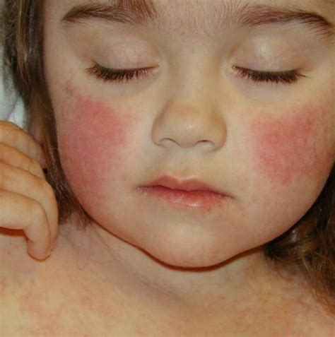 A Visual Guide To Viral Rashes Viral Rash Rash On Face Skin | Images ...