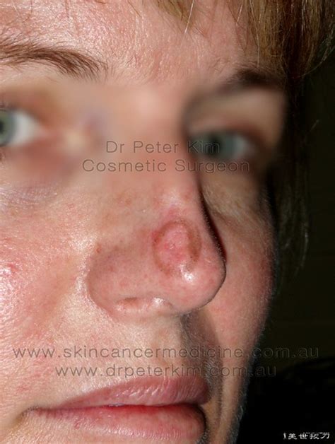 BCC nose 3 | BCC nose early detection may save your life www… | Flickr