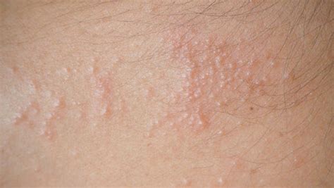 How to Get Rid of Heat Rash Quickly: 6 Home Remedies