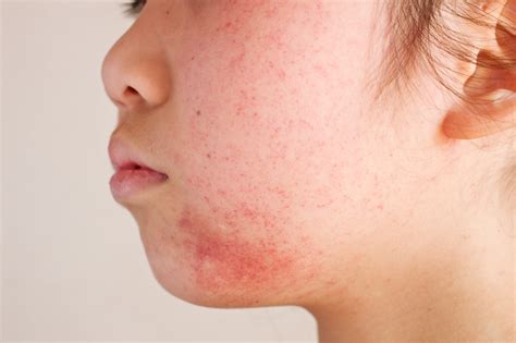 Dermatitis Treatment | U.S. Dermatology Partners