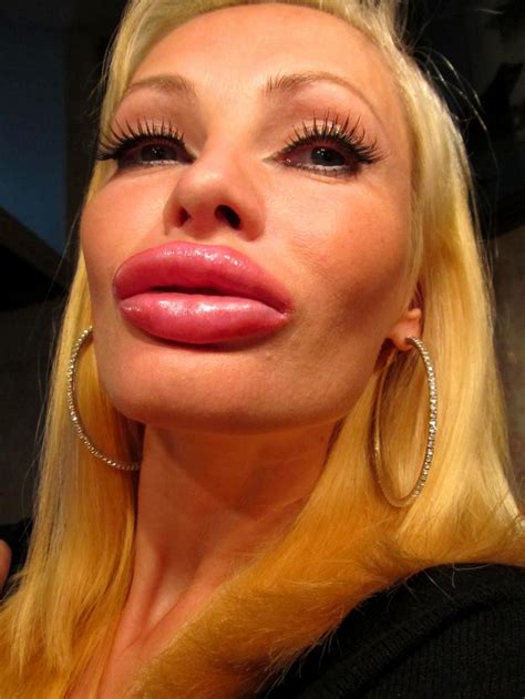 Big lips, Plastic surgery, Fake lips