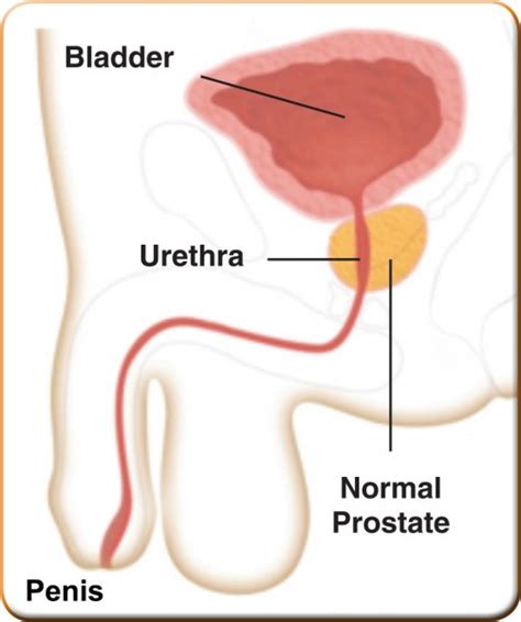 What is BPH? | Manchester Urology Associates, PA