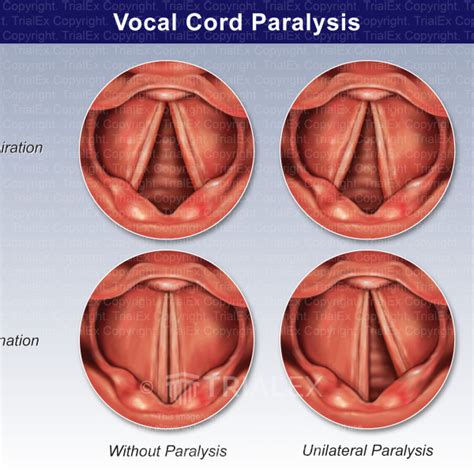 Vocal Cord Paralysis - TrialQuest Inc.