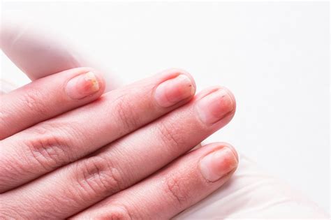 Infected cuticles: causes and the best treatment for cuticle damage