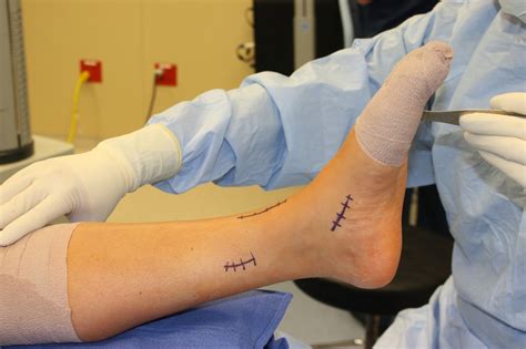 Foot Drop Treatment (Tendon Transfer) | FootCareMD