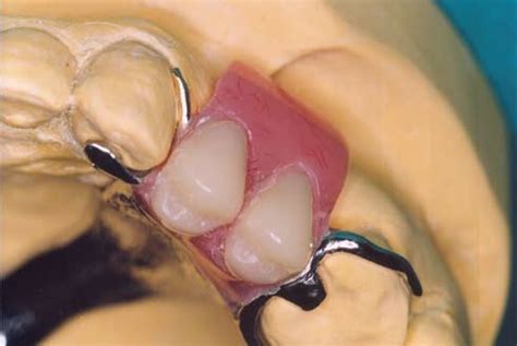 A Modified Circumferential/ C-clasp on the canine. The clasp engages a ...