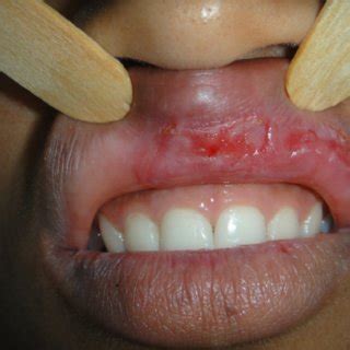 Syphilis Tongue Lesions