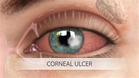 Corneal Ulcer Diagnosis, Treatment, Complication - Rxharun