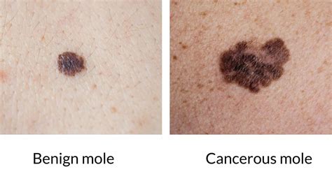 Pictures of cancerous moles: early stage, cancerous moles images ...