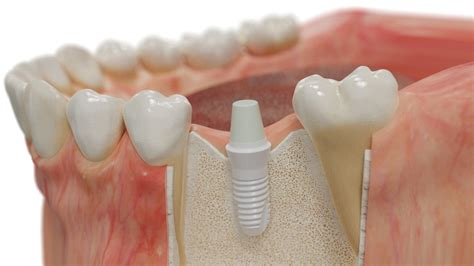 Ceramic implant - Leading Implant Centers