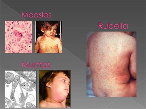 Measles, mumps and rubella