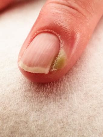 Cuticle Infection | LoveToKnow Health & Wellness