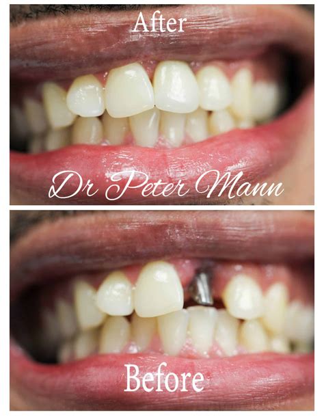 Tooth Implant Before After