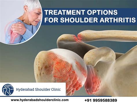 shoulder arthritis exercises - shoulder clinic Hyderabad